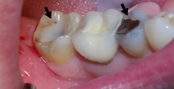 Step By Step Dental Filling Procedure - Dr. Elston Wong Dentistry