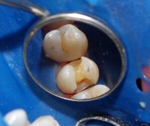 Basic Steps Involved in a Dental Filling Procedure - Fisher Pointe